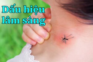 Dấu hiệu lâm sàng của sốt xuất huyết