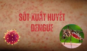 dấu hiệu sốt xuất huyết