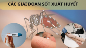 các giai đoạn sốt xuất huyết