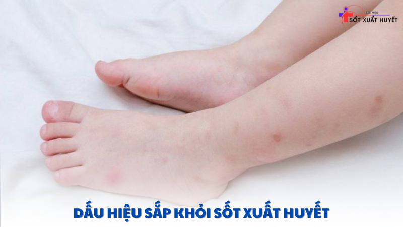 dấu hiệu sắp khỏi sốt xuất huyết