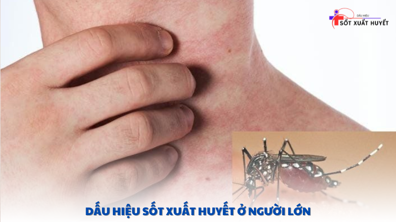 dấu hiệu sốt xuất huyết ở người lớn