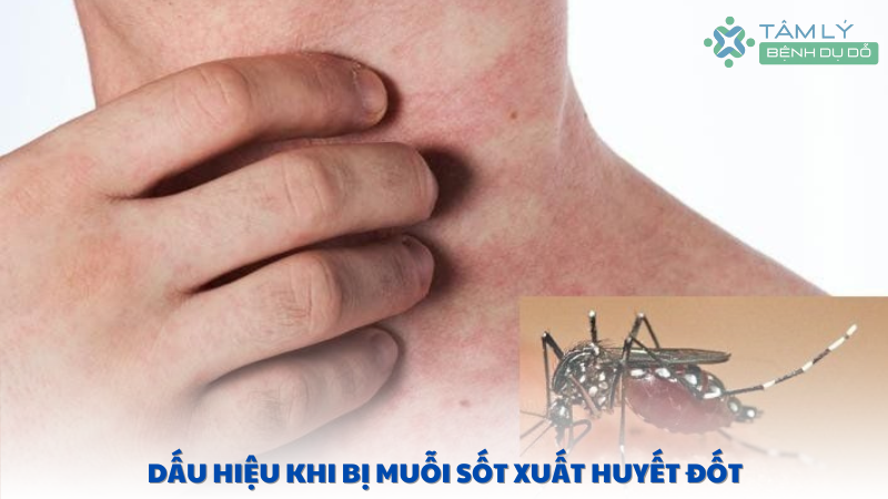 dấu hiệu khi bị muỗi sốt xuất huyết đốt